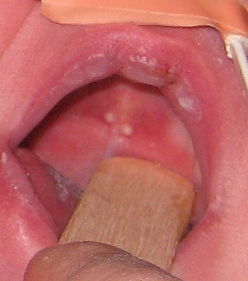 White Spots In Baby Mouth 15