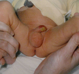 baby circumcision infection