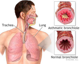 What triggers asthma? An asthmatic bronchiole is shown blocked